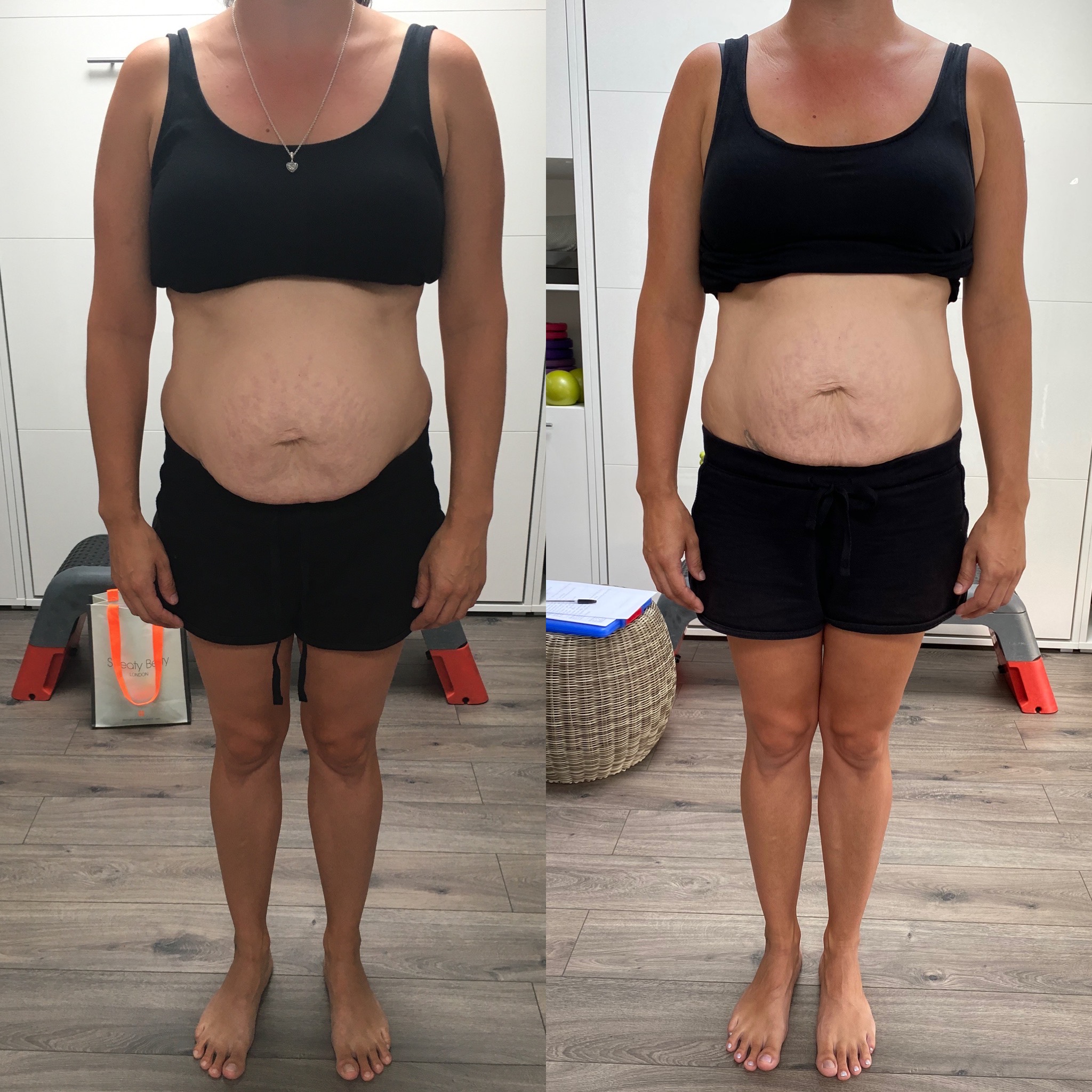 Before and After Images of Diastasis Client 