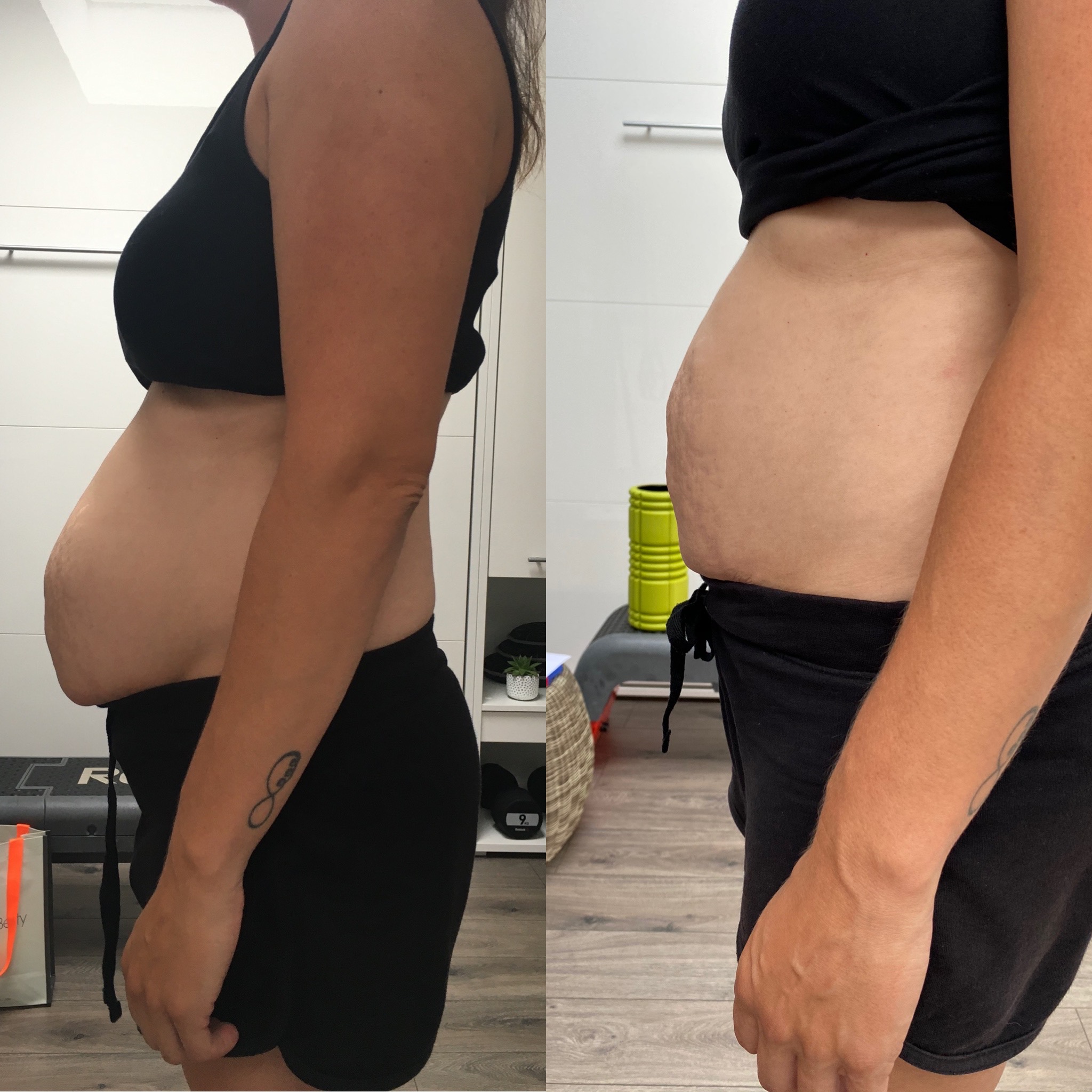Before and After Images of Diastasis Client - taken 6 weeks apart